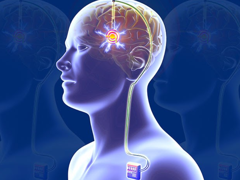 Various Wireless Power Transfer Techniques in Neural Stimulators and Other Implantable Medtech